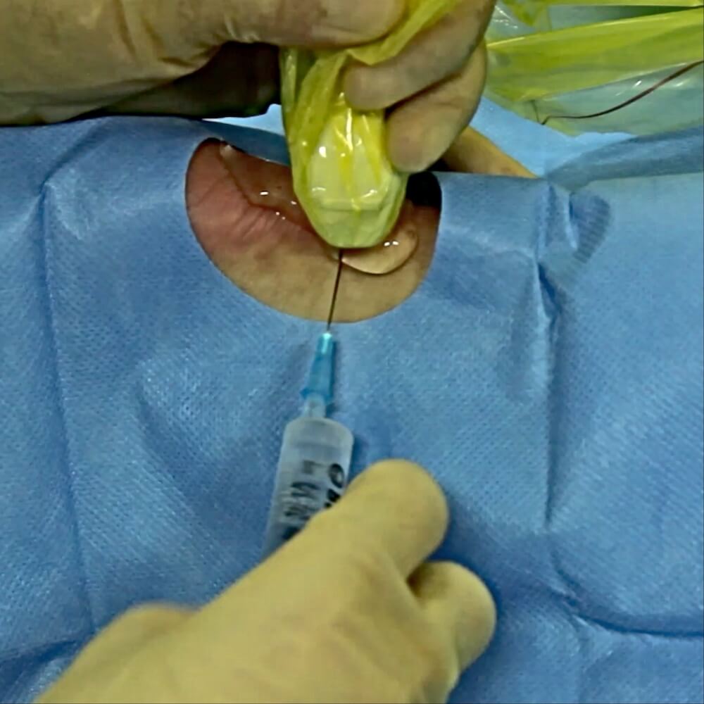 Injection under ultrasound for accurate administration