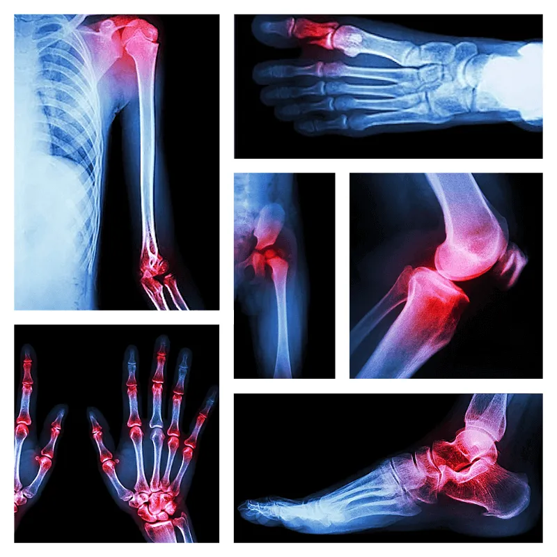 Bones & Joints